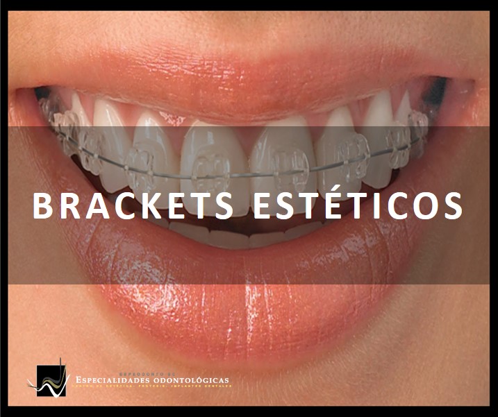 Está compuesta de elementos adheridos a los dientes (bandas y brackets ceramicos) a los que se ancla firmemente unos finos arcos.