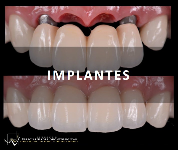 Cuando faltan varios dientes adyacentes, un puente con el soporte de implantes es un excelente tratamiento para reemplazarlos.