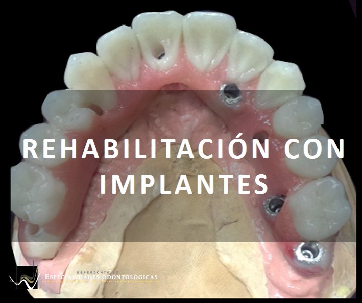 Es posible lograr remplazar todos los dientes mediante una restauración múltiple de implantes con dentaduras fijas o semiremovibles ancladas sobre implantes.