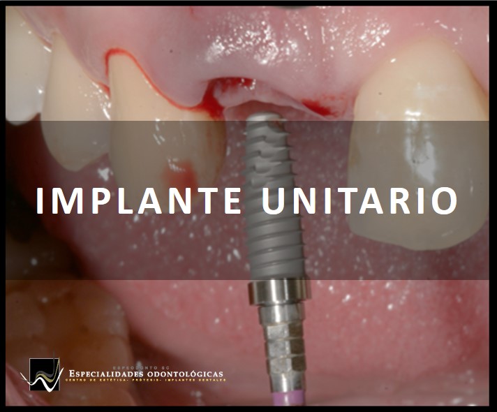 La perdia de una diente puede ser reemplazado por un implante dental sin llegar a maltratar los dientes adyacentes.