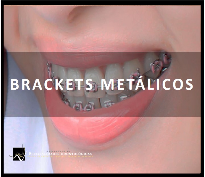 Está compuesta de elementos adheridos a los dientes (bandas y brackets) a los que se ancla firmemente unos finos arcos elásticos.