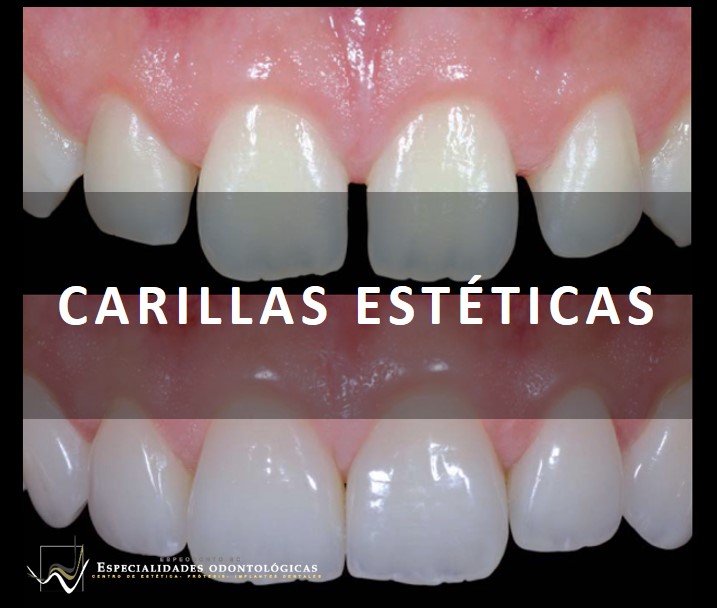 Las carillas dentales son prótesis finas que se pegan en la superficie anterior de los dientes, proporcionando una apariencia natural y atractiva.