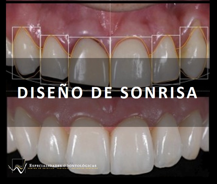 El diseño de sonrisa consiste en llevar los dientes a unas condiciones ideales de tamaño forma y color, según la cara, la personalidad y los rasgos específicos de cada paciente.