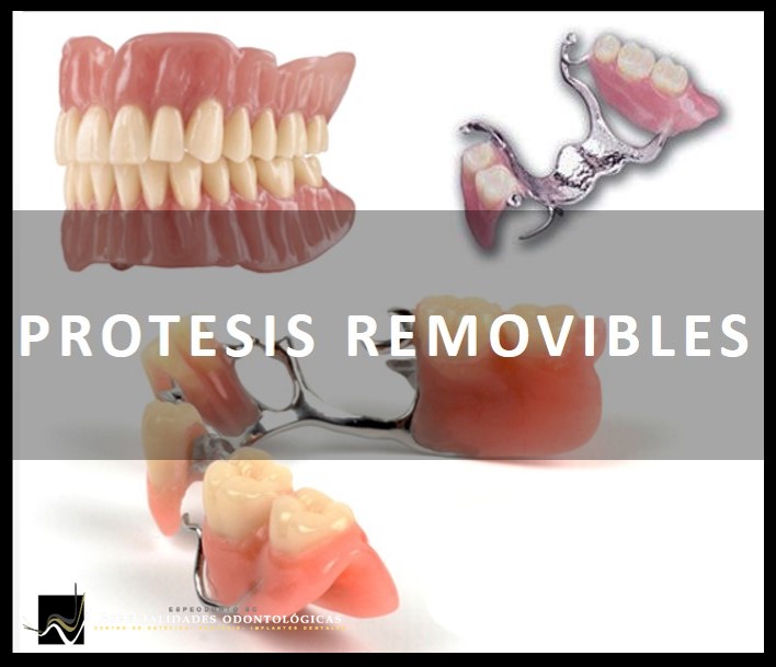 La ausencia parcial o toral de dientes pueden ser reemplazados por dentaduras parciales o totales que restauran la estétcia y funcionalidad.